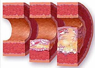 Stages of development of atherosclerotic plaque in a vessel with hypertension. 